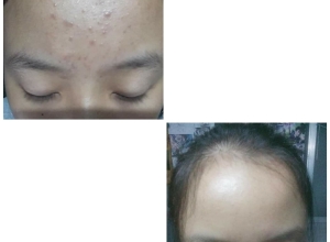  feedback trị mụn sau khi sử dụng sản phẩm Dr.Mai tại hệ thống https://drmaichinhhang.vn/