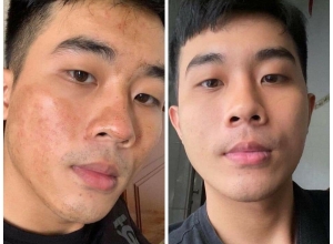  feedback trị mụn sau khi sử dụng sản phẩm Dr.Mai tại hệ thống https://drmaichinhhang.vn/