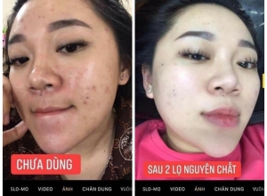  feedback trị mụn sau khi sử dụng sản phẩm Dr.Mai tại hệ thống https://drmaichinhhang.vn/