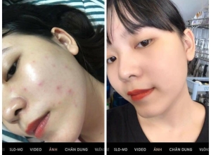  feedback trị mụn sau khi sử dụng sản phẩm Dr.Mai tại hệ thống https://drmaichinhhang.vn/