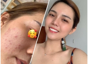  feedback trị mụn sau khi sử dụng sản phẩm Dr.Mai tại hệ thống https://drmaichinhhang.vn/