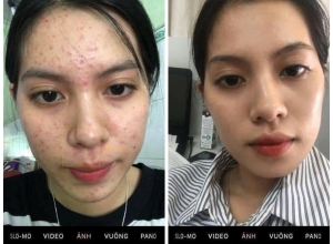  feedback trị mụn sau khi sử dụng sản phẩm Dr.Mai tại hệ thống https://drmaichinhhang.vn/