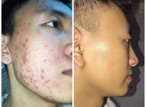  feedback trị mụn sau khi sử dụng sản phẩm Dr.Mai tại hệ thống https://drmaichinhhang.vn/