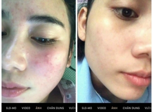  feedback trị mụn sau khi sử dụng sản phẩm Dr.Mai tại hệ thống https://drmaichinhhang.vn/