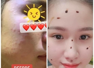  feedback trị mụn sau khi sử dụng sản phẩm Dr.Mai tại hệ thống https://drmaichinhhang.vn/