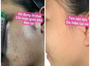  feedback trị mụn sau khi sử dụng sản phẩm Dr.Mai tại hệ thống https://drmaichinhhang.vn/