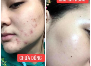  feedback trị mụn sau khi sử dụng sản phẩm Dr.Mai tại hệ thống https://drmaichinhhang.vn/