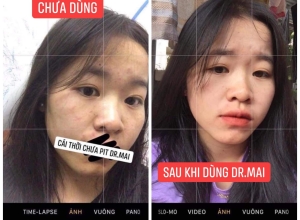  feedback trị mụn sau khi sử dụng sản phẩm Dr.Mai tại hệ thống https://drmaichinhhang.vn/