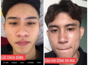  feedback trị mụn sau khi sử dụng sản phẩm Dr.Mai tại hệ thống https://drmaichinhhang.vn/