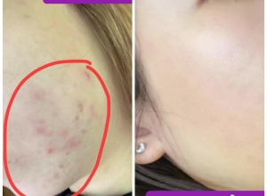  feedback trị mụn sau khi sử dụng sản phẩm Dr.Mai tại hệ thống https://drmaichinhhang.vn/