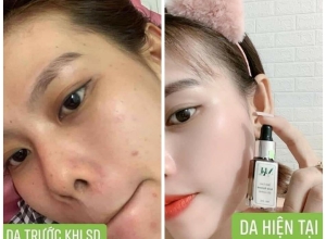  feedback trị mụn sau khi sử dụng sản phẩm Dr.Mai tại hệ thống https://drmaichinhhang.vn/