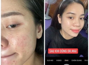  feedback trị mụn sau khi sử dụng sản phẩm Dr.Mai tại hệ thống https://drmaichinhhang.vn/