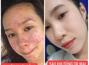  feedback trị mụn sau khi sử dụng sản phẩm Dr.Mai tại hệ thống https://drmaichinhhang.vn/