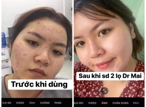  feedback trị mụn sau khi sử dụng sản phẩm Dr.Mai tại hệ thống https://drmaichinhhang.vn/