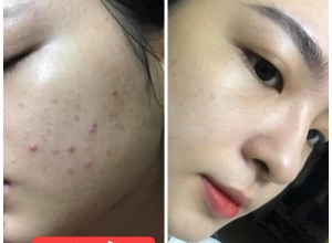  feedback trị mụn sau khi sử dụng sản phẩm Dr.Mai tại hệ thống https://drmaichinhhang.vn/