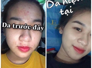  feedback trị mụn sau khi sử dụng sản phẩm Dr.Mai tại hệ thống https://drmaichinhhang.vn/