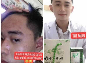  feedback trị mụn sau khi sử dụng sản phẩm Dr.Mai tại hệ thống https://drmaichinhhang.vn/