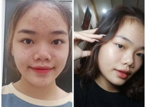  feedback trị mụn sau khi sử dụng sản phẩm Dr.Mai tại hệ thống https://drmaichinhhang.vn/