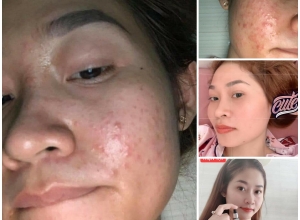  feedback trị mụn sau khi sử dụng sản phẩm Dr.Mai tại hệ thống https://drmaichinhhang.vn/