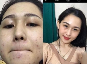  feedback trị mụn sau khi sử dụng sản phẩm Dr.Mai tại hệ thống https://drmaichinhhang.vn/