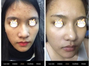  feedback trị mụn sau khi sử dụng sản phẩm Dr.Mai tại hệ thống https://drmaichinhhang.vn/