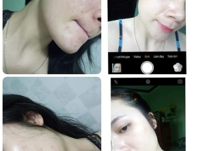  feedback trị mụn sau khi sử dụng sản phẩm Dr.Mai tại hệ thống https://drmaichinhhang.vn/