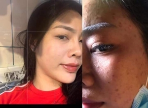  feedback trị mụn sau khi sử dụng sản phẩm Dr.Mai tại hệ thống https://drmaichinhhang.vn/