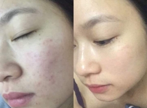  feedback trị mụn sau khi sử dụng sản phẩm Dr.Mai tại hệ thống https://drmaichinhhang.vn/