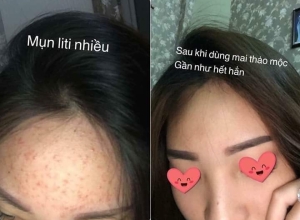  feedback trị mụn sau khi sử dụng sản phẩm Dr.Mai tại hệ thống https://drmaichinhhang.vn/