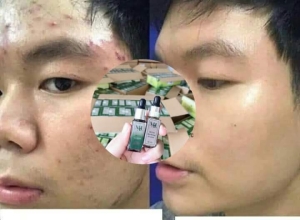  feedback trị mụn sau khi sử dụng sản phẩm Dr.Mai tại hệ thống https://drmaichinhhang.vn/