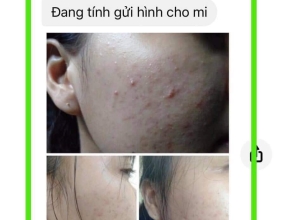  feedback trị mụn sau khi sử dụng sản phẩm Dr.Mai tại hệ thống https://drmaichinhhang.vn/