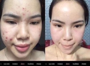  feedback trị mụn sau khi sử dụng sản phẩm Dr.Mai tại hệ thống https://drmaichinhhang.vn/