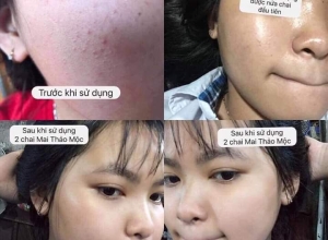  feedback trị mụn sau khi sử dụng sản phẩm Dr.Mai tại hệ thống https://drmaichinhhang.vn/