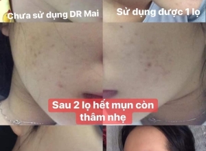  feedback trị mụn sau khi sử dụng sản phẩm Dr.Mai tại hệ thống https://drmaichinhhang.vn/