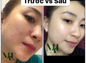  feedback trị mụn sau khi sử dụng sản phẩm Dr.Mai tại hệ thống https://drmaichinhhang.vn/