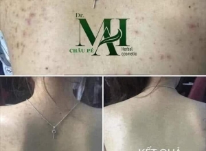  feedback trị mụn sau khi sử dụng sản phẩm Dr.Mai tại hệ thống https://drmaichinhhang.vn/