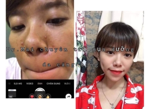  feedback trị mụn sau khi sử dụng sản phẩm Dr.Mai tại hệ thống https://drmaichinhhang.vn/