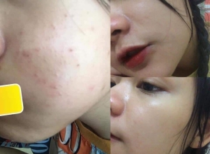  feedback trị mụn sau khi sử dụng sản phẩm Dr.Mai tại hệ thống https://drmaichinhhang.vn/