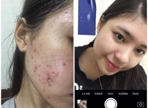  feedback trị mụn sau khi sử dụng sản phẩm Dr.Mai tại hệ thống https://drmaichinhhang.vn/