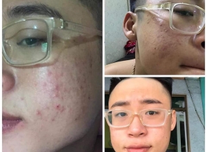  feedback trị mụn sau khi sử dụng sản phẩm Dr.Mai tại hệ thống https://drmaichinhhang.vn/