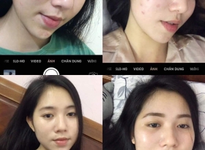  feedback trị mụn sau khi sử dụng sản phẩm Dr.Mai tại hệ thống https://drmaichinhhang.vn/