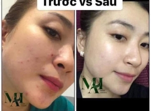  feedback trị mụn sau khi sử dụng sản phẩm Dr.Mai tại hệ thống https://drmaichinhhang.vn/
