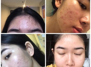  feedback trị mụn sau khi sử dụng sản phẩm Dr.Mai tại hệ thống https://drmaichinhhang.vn/