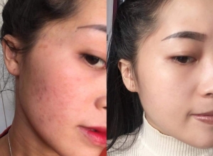  feedback trị mụn sau khi sử dụng sản phẩm Dr.Mai tại hệ thống https://drmaichinhhang.vn/