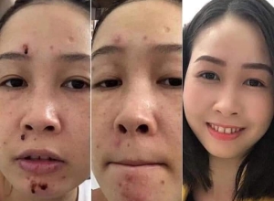  feedback trị mụn sau khi sử dụng sản phẩm Dr.Mai tại hệ thống https://drmaichinhhang.vn/