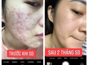  feedback trị mụn sau khi sử dụng sản phẩm Dr.Mai tại hệ thống https://drmaichinhhang.vn/