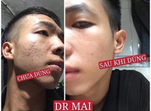  feedback trị mụn sau khi sử dụng sản phẩm Dr.Mai tại hệ thống https://drmaichinhhang.vn/