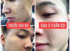  feedback trị mụn sau khi sử dụng sản phẩm Dr.Mai tại hệ thống https://drmaichinhhang.vn/