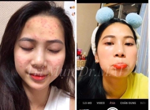 feedback trị mụn sau khi sử dụng sản phẩm Dr.Mai tại hệ thống https://drmaichinhhang.vn/