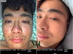  feedback trị mụn sau khi sử dụng sản phẩm Dr.Mai tại hệ thống https://drmaichinhhang.vn/